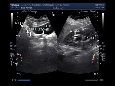 Kidney Stone Ultrasound