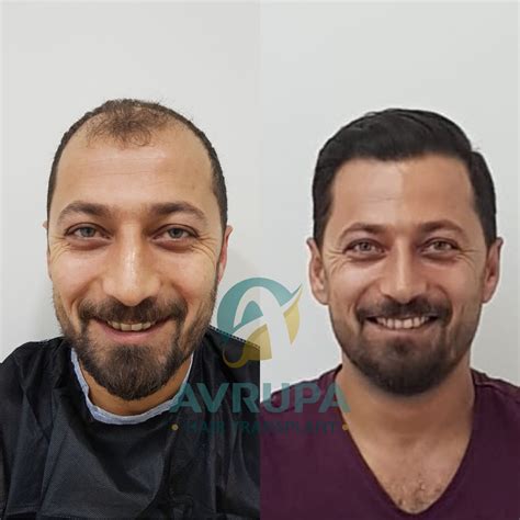 FUE Hair Transplant Results : 10 Real Cases With Photos - Clinic Advisor