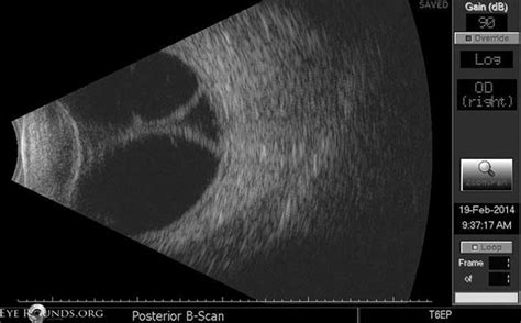 Choroidal Detachment: Serous, Appositional/Kissing