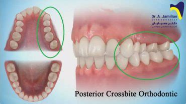 Posterior crossbite orthodontic - Dr Jamilian