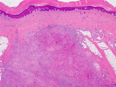 Pathology Outlines - Epithelioid sarcoma