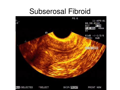 PPT - The Pelvic Scan: Early pregnancy problems Gynaecological abnormalities PowerPoint ...