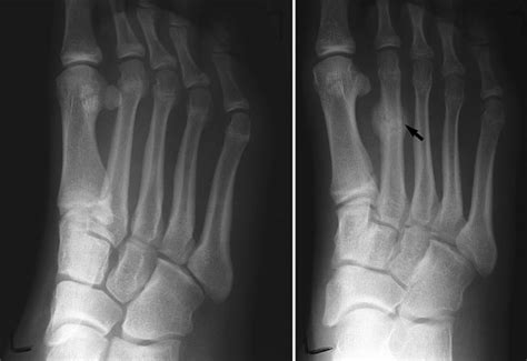 What Are Stress Fractures Of The Feet? - Sutherland Podiatry Sutherland ...