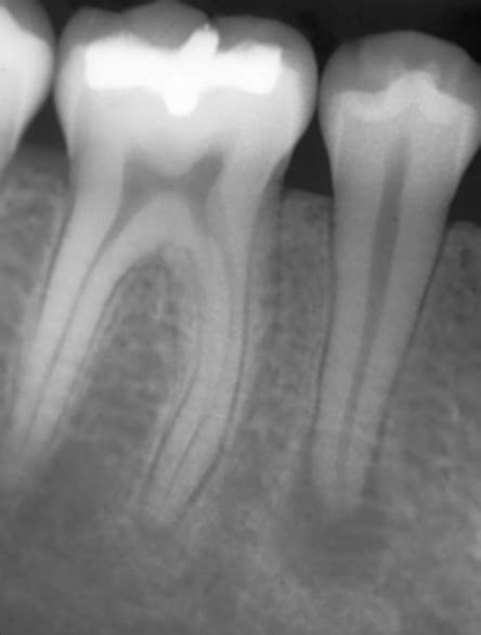 Apical periodontitis - Differential diagnosis