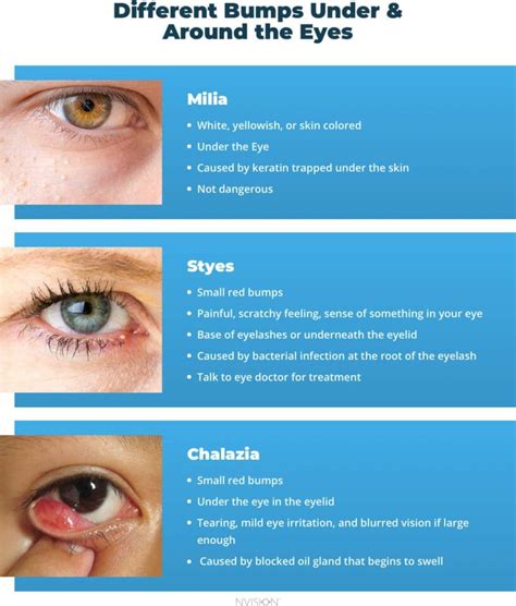 Bumps Under the Eyes: Types & How to Treat Them – NVISION