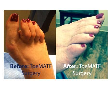 Hammertoe Surgery & Hammertoe Correction Solutions - Anika