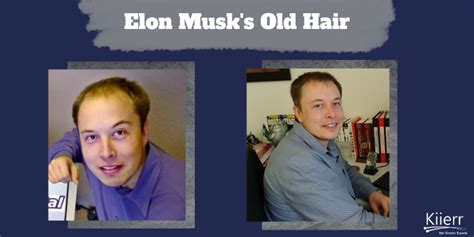 How Elon Musk Restored His Hair - Kiierr Hair Growth Experts