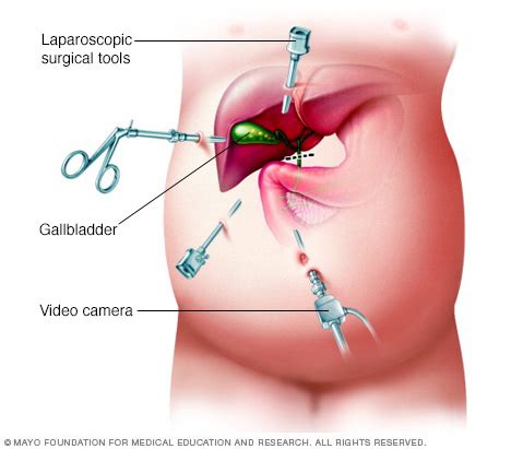 Laparoscopic Cholecystectomy