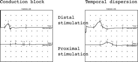 Nerve conduction study, EMG nerve conduction study & side effects