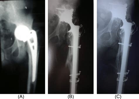 A 61-year-old female patient with failed hemiarthroplasty of the left ...