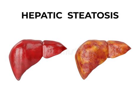 Hepatic Steatosis is a Disorder Characterized by the Accumulation of ...