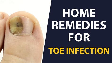 Home Remedies To Get Rid Of A Toe Infection Fast | Remedies For A Toe ...