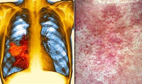 Lung cancer symptoms: Signs of a tumour include an itchy rash on your skin | Express.co.uk