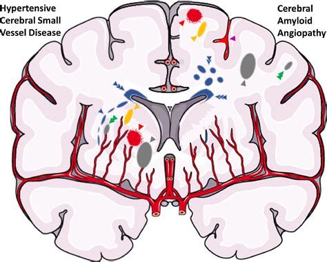 Pathophysiology of Lacunar Stroke: History's Mysteries and Modern ...