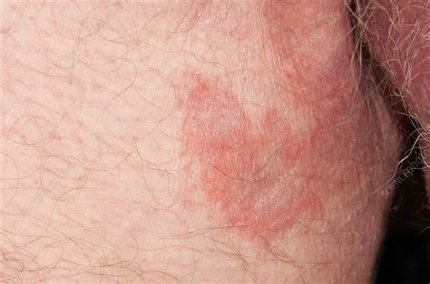 Ringworm fungus on the groin - Stock Image C011/0371 - Science Photo Library