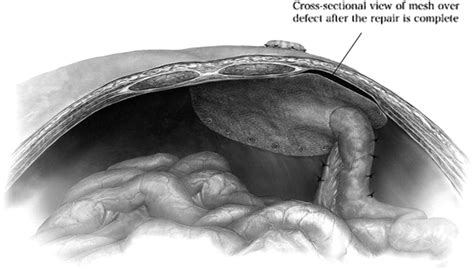 Colostomy Hernia Repair at Brittney Spencer blog