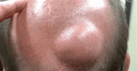 Dr Pimple Popper just squeezed a big cyst from a man's head and fans think it looks like churros ...