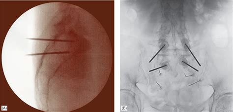 Percutaneous Sacroplasty | Anesthesia Key