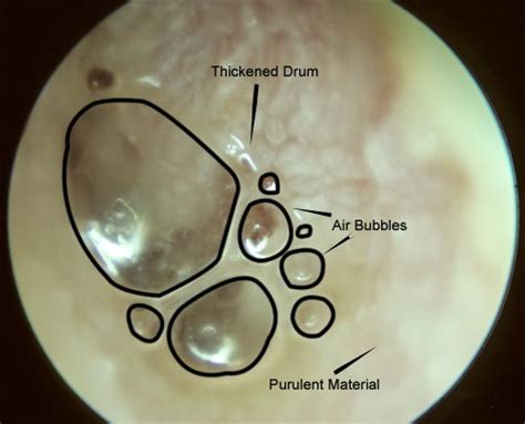 Chronic Ear Infection Images | McGovern Medical School