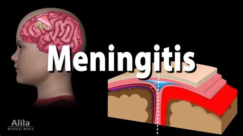 Meningitis: Pathology, Causes, Symptoms, Diagnosis and Treatment, Animation - YouTube