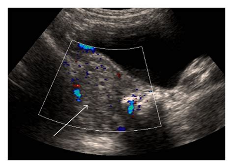 Doppler ultrasound of a large right ovarian cyst (estimated ovarian... | Download Scientific Diagram