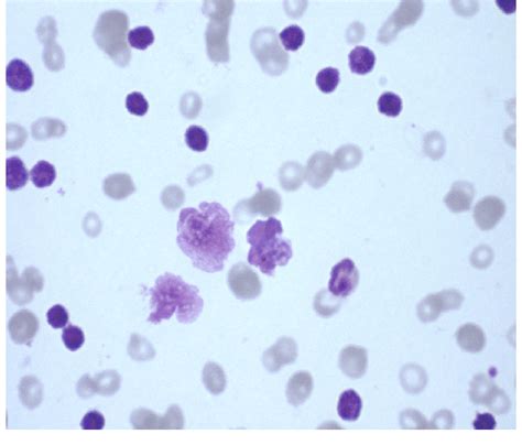 Peripheral blood smear (leishman stain, 1009) showing smudge cells ...