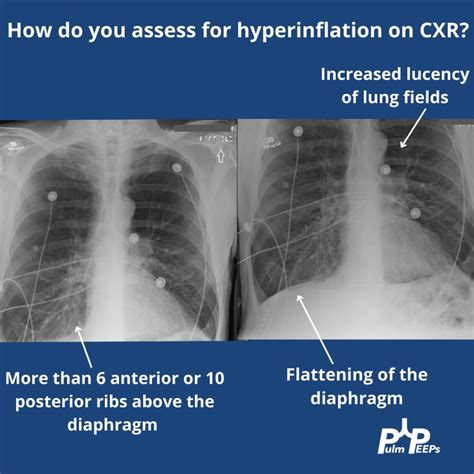 Hyperinflation Chest X Ray