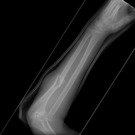 Monteggia Fracture X Ray