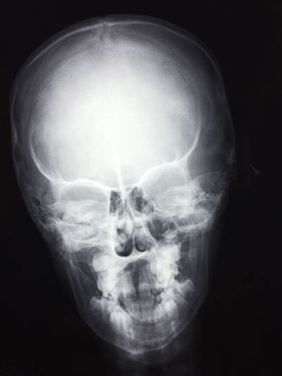 What is a Skull Xray? | Two Views