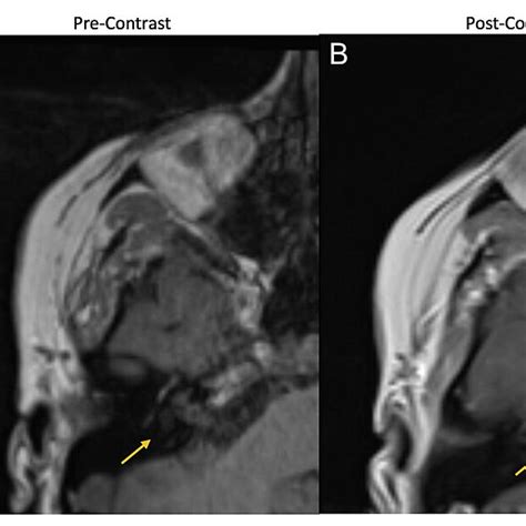 Right IAC lesion on MRI with and without contrast at subacute (two days... | Download Scientific ...