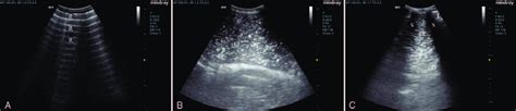 Critical care ultrasound findings at the McBurney's point (A), reverse ...