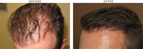 39+ artas hair transplant before and after - ArochaAnania