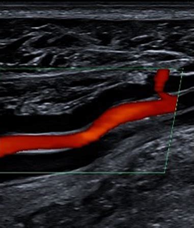 Vascular Ultrasound - Insight Medical Imaging