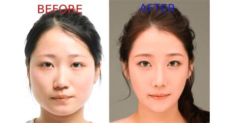 8 Most Popular Plastic Surgery Procedures In Korea