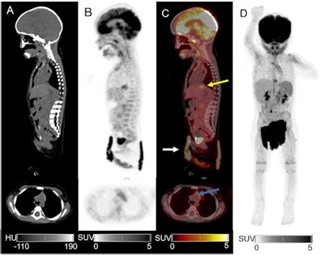 Whole-body PET/CT for a child: 5 minutes, no sedation