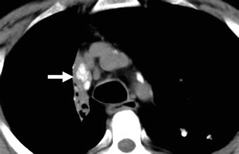 Lymph node calcification. Axial CT shows right paratracheal calcified ...