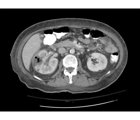 Pyelonephritis CT scan - wikidoc