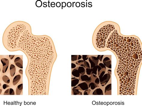 group_5_presentation_1_-_osteoporosis - Wiki