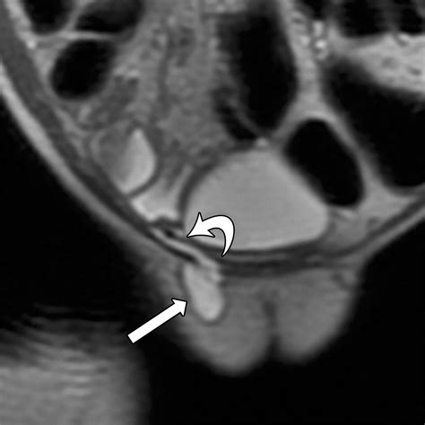 From Inguinal Hernias to Spermatic Cord Lipomas: Pearls, Pitfalls, and ...