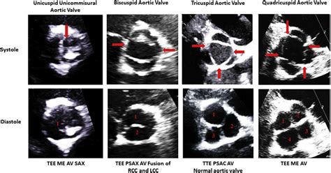 The number of points of commissural contact with the aortic root is a ...