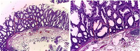 GASTROINTESTINAL AND LIVER HISTOLOGY PATHOLOGY ATLAS: SESSILE SERRATED POLYP (AKA SESSILE ...