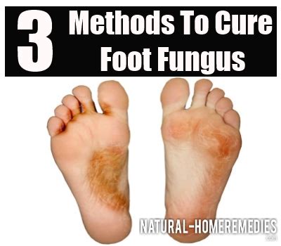 3 Effective Methods To Cure Foot Fungus - How To Treat Foot Fungus ...