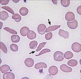 Sickle Cell Anemia - Hematology - Medbullets Step 1