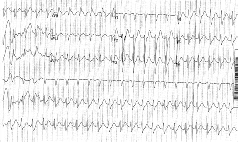 ECG of the Week – 18th December 2019 | Emergucate