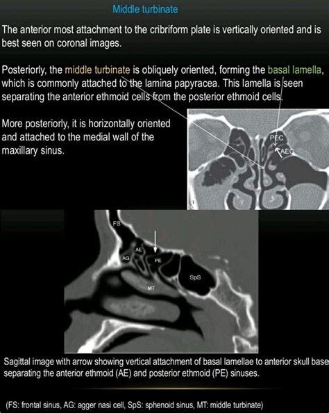 The anterosuperior wall of middle turbinate is an important land mark, especially in revision ...