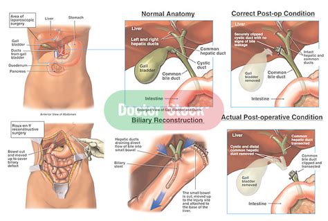 Laparoscopic Cholecystectomy Procedure with Subsequent Bile Duct Injury ...