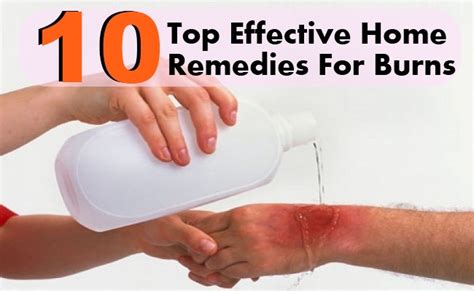 Home Remedies for Burn (Ways to Treat a Burn at Home)