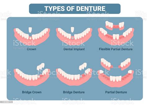 Dental Prosthesis Types Educational Medical Scheme With Names Isometric Vector Illustration ...