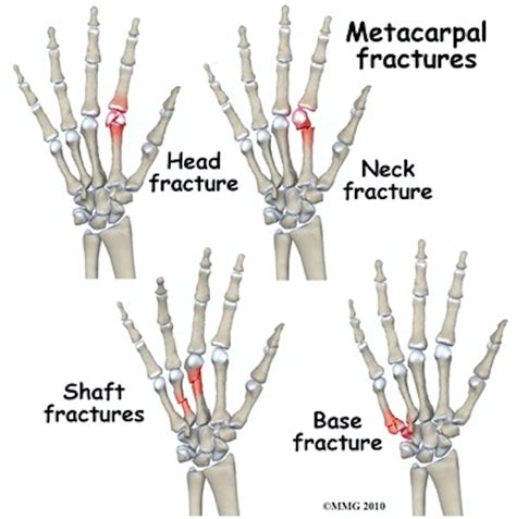 Metacarpal Fractures – Core EM