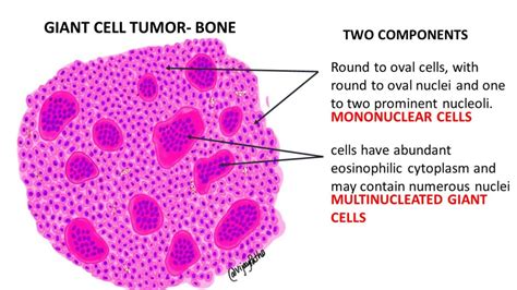 GIANT CELL TUMOR- BONE | Pathology Made Simple